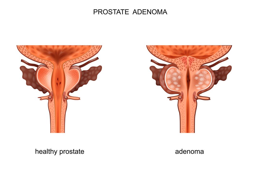 Prostata eta adenoma osasuntsua