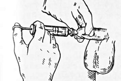 prostatitisaren instilazioa