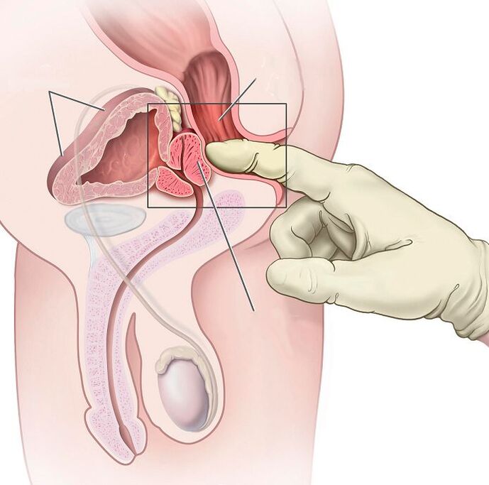 Prostatako masajea prostatitisaren tratamendurako