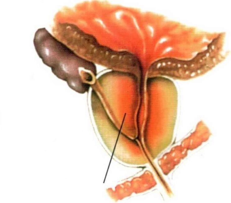 Prostatako ehunaren hantura prostatitis kronikoan